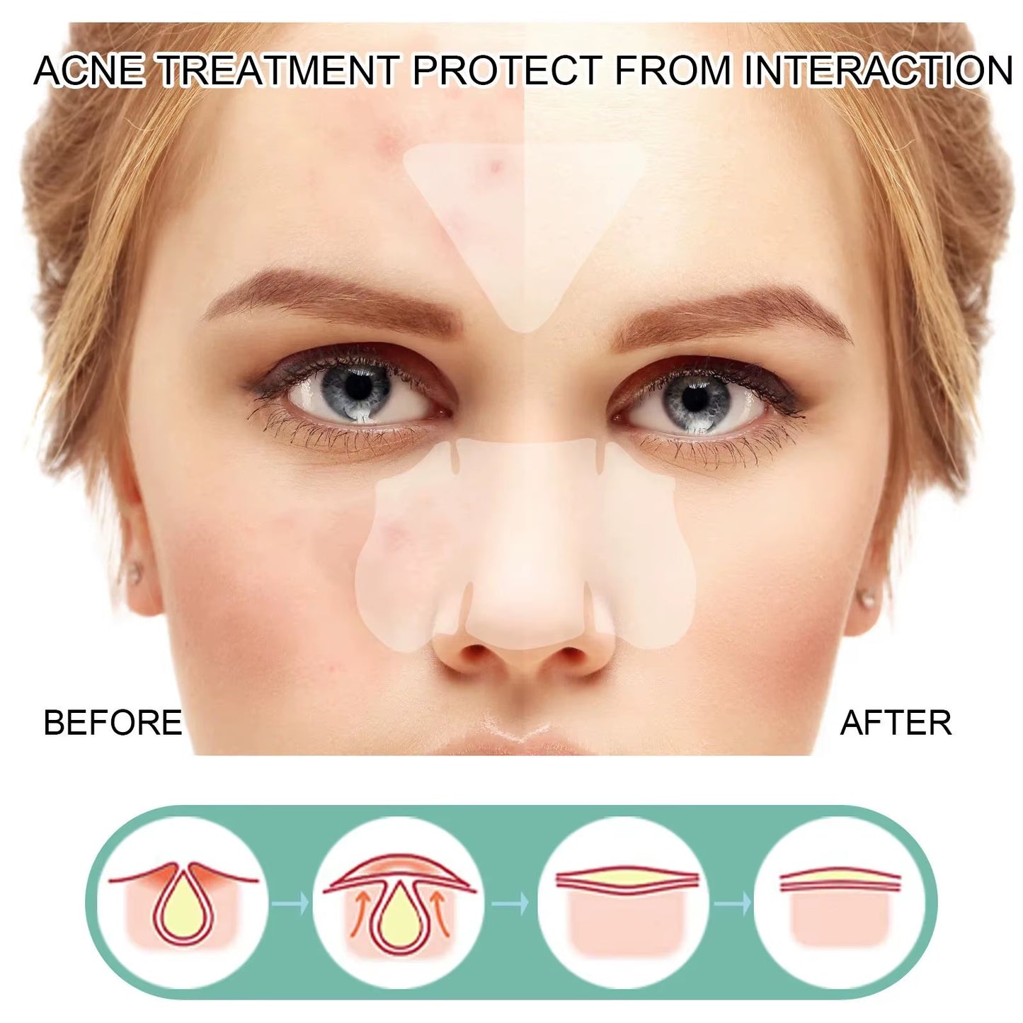 Acne Mask Patch Facial Treatment Desalinate Pimple Marks Pimple Patch Mild and Non-Irritating Healing Acne Acne Repair Patch