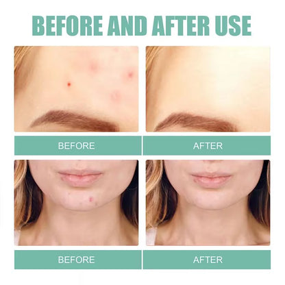 Acne Mask Patch Facial Treatment Desalinate Pimple Marks Pimple Patch Mild and Non-Irritating Healing Acne Acne Repair Patch